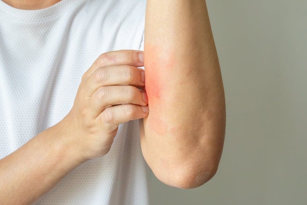 Sanofi abandons eczema drug approval efforts in another blow to OX40 class