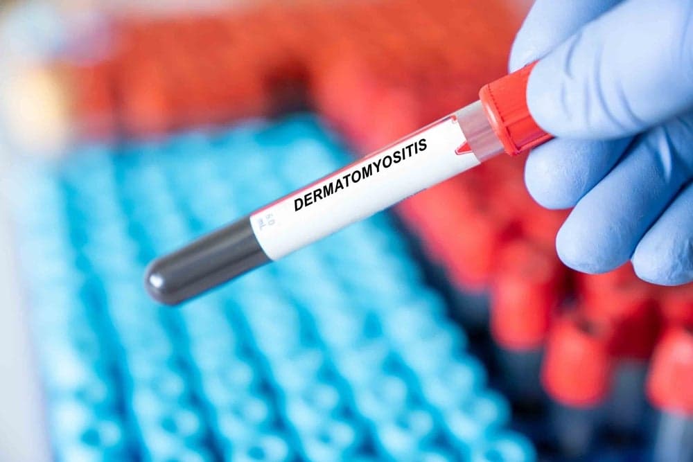 FDA approves Priovant’s rare autoimmune therapy Lisraya in indication first